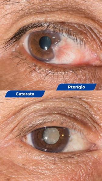 ​Madre de Deus de Minas recebe documentação para mutirão de cirurgias de catarata e pterígio